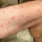 Vagabond Tales-  It’s Chig, Chig, Chigger Time🎶- Not a Song You Want to Join Us In